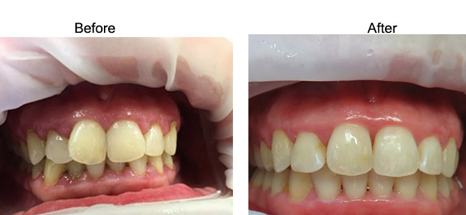 Before-and-After-Quick-Straight-Teeth