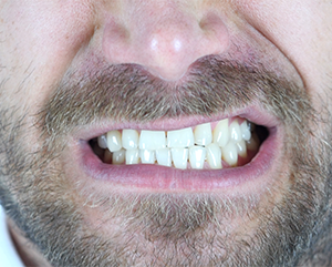 How To Stop Teeth Grinding